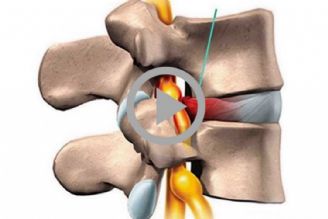 پیشگیری و درمان اختلال دیسك كمر
