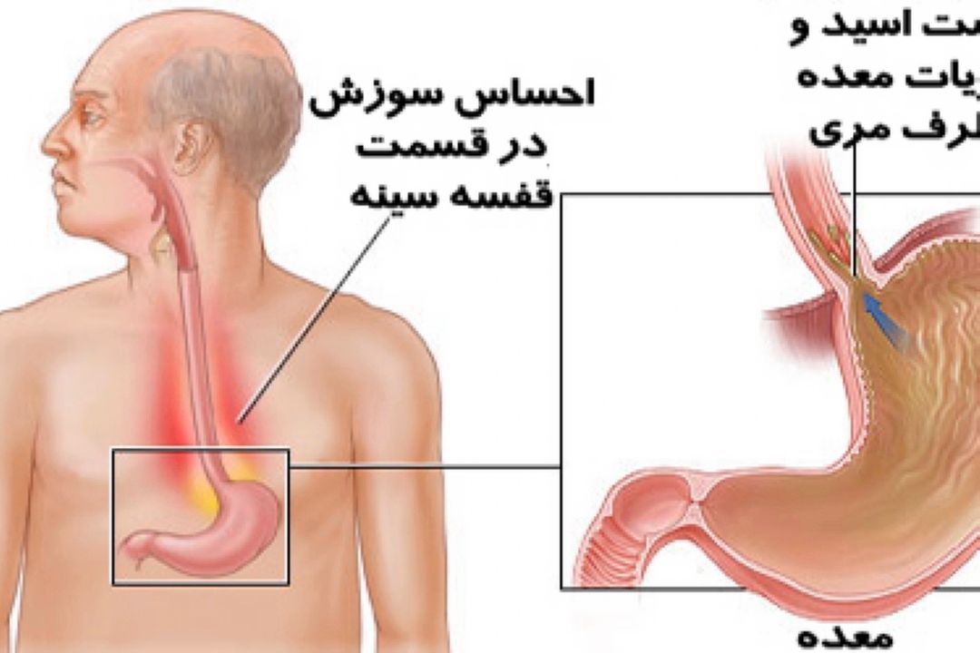 در برنامه نبض دوشنبه هفتم آبان درباره ریفلاكس معده صحبت میكنیم
