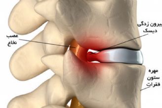 علائم هشدار دهنده دیسك كمر