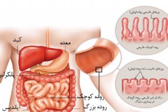 در برنامه نبض چهارشنبه شانزدهم آبان درباره بیماری سلیاك صحبت شد