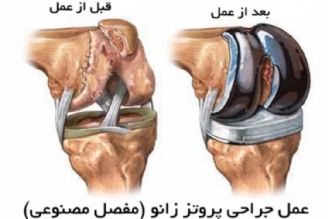 در برنامه نبض دوشنبه بیست و یكم آبان درباره تعویض مفصل زانو صحبت میكنیم