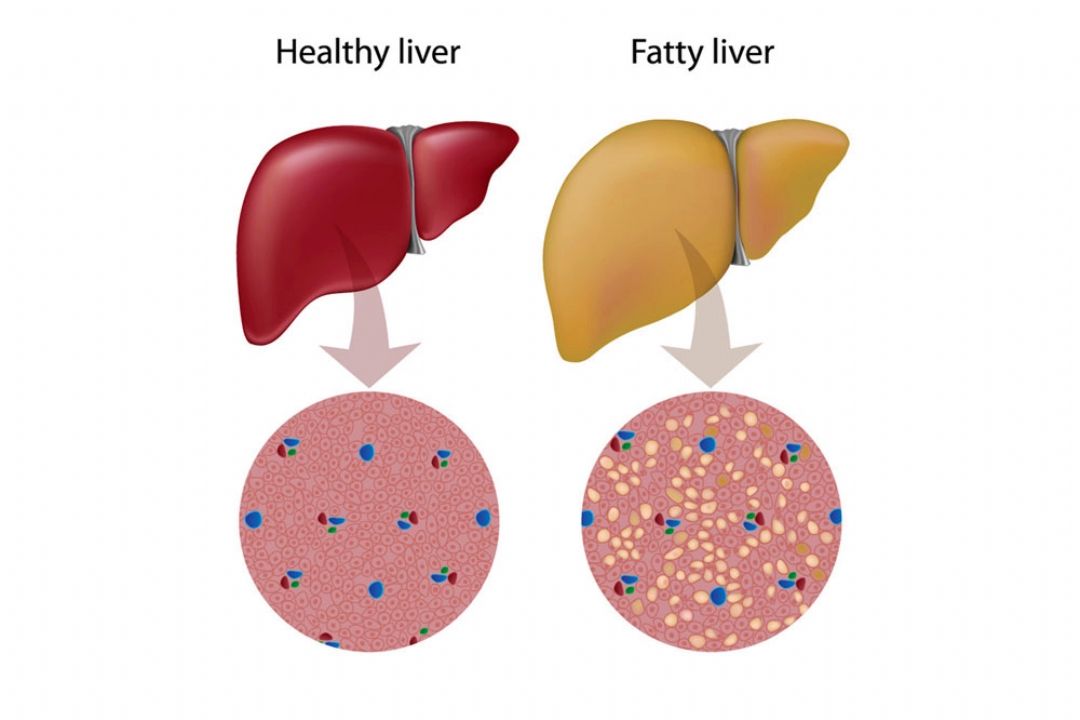 سالانه بیش از 500 میلیون نفر به كبد چرب مبتلا می شوند/ افزایش وزن و چاقی، مهمترین عامل خطر 