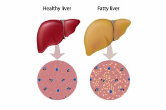 سالانه بیش از 500 میلیون نفر به كبد چرب مبتلا می شوند/ افزایش وزن و چاقی، مهمترین عامل خطر 