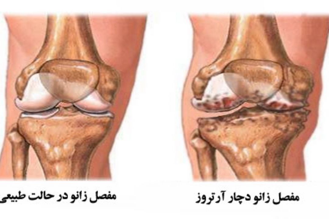 در برنامه نبض دوشنبه دوازدهم آذر درباره آرتروز زانو صحبت میكنیم