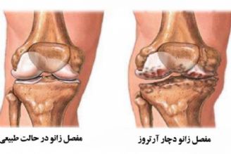 در برنامه نبض دوشنبه دوازدهم آذر درباره آرتروز زانو صحبت میكنیم