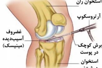 راهكارهای درمانی آسیب ACL و مینیسك 