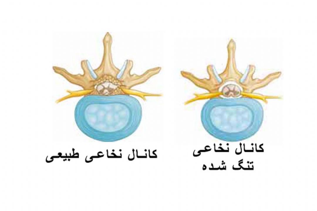 استفاده طولانی مدت از وسایل دیجیتال، آغاز تنگی كانال نخاع