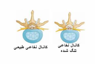 استفاده طولانی مدت از وسایل دیجیتال، آغاز تنگی كانال نخاع