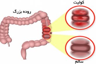 در برنامه نبض سه شنبه یازدهم دی درباره كولیت روده صحبت شد