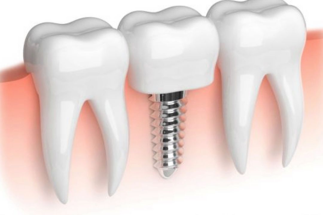 ایمپلنت معجزه دندانپزشكی در قرن اخیر