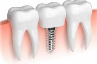 ایمپلنت معجزه دندانپزشكی در قرن اخیر