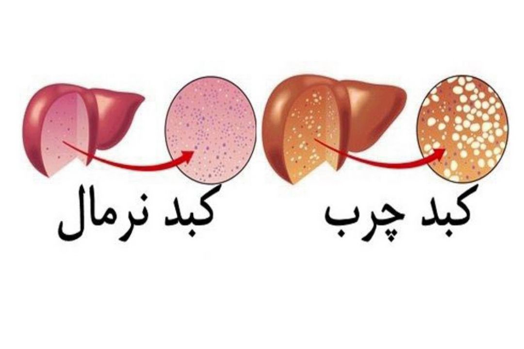 در برنامه نبض سه شنبه بیست و پنجم دی درباره كبد چرب صحبت شد