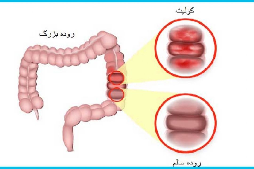 در برنامه نبض سه شنبه بیست و سوم بهمن درباره كولیت روده صحبت شد