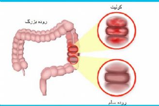 در برنامه نبض سه شنبه بیست و سوم بهمن درباره كولیت روده صحبت شد