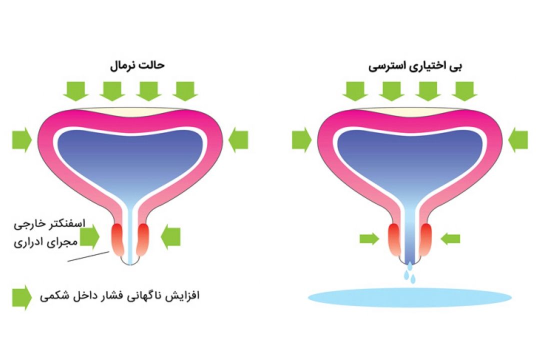 در برنامه نبض دوشنبه هفتم اسفند درباره بی اختیاری ادراری صحبت شد