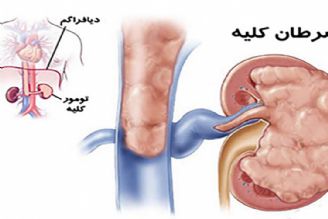 در برنامه نبض سه شنبه بیست و یكم اسفند درباره تومور كلیه صحبت شد