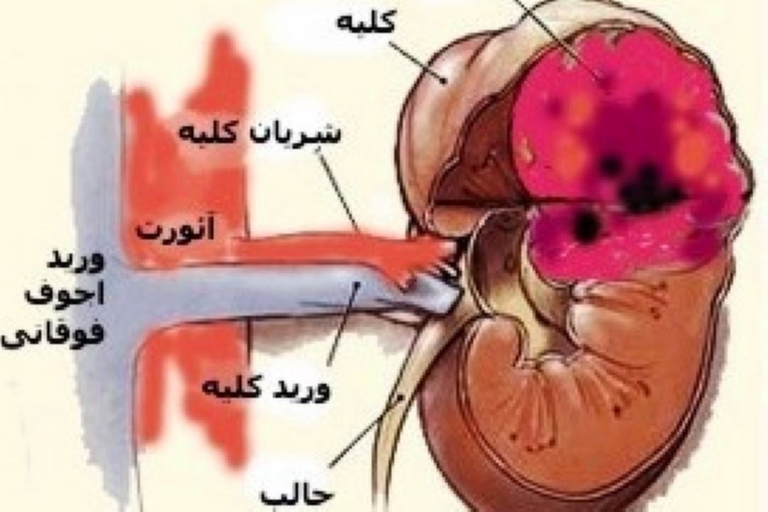 تومورهایی در كلیه 