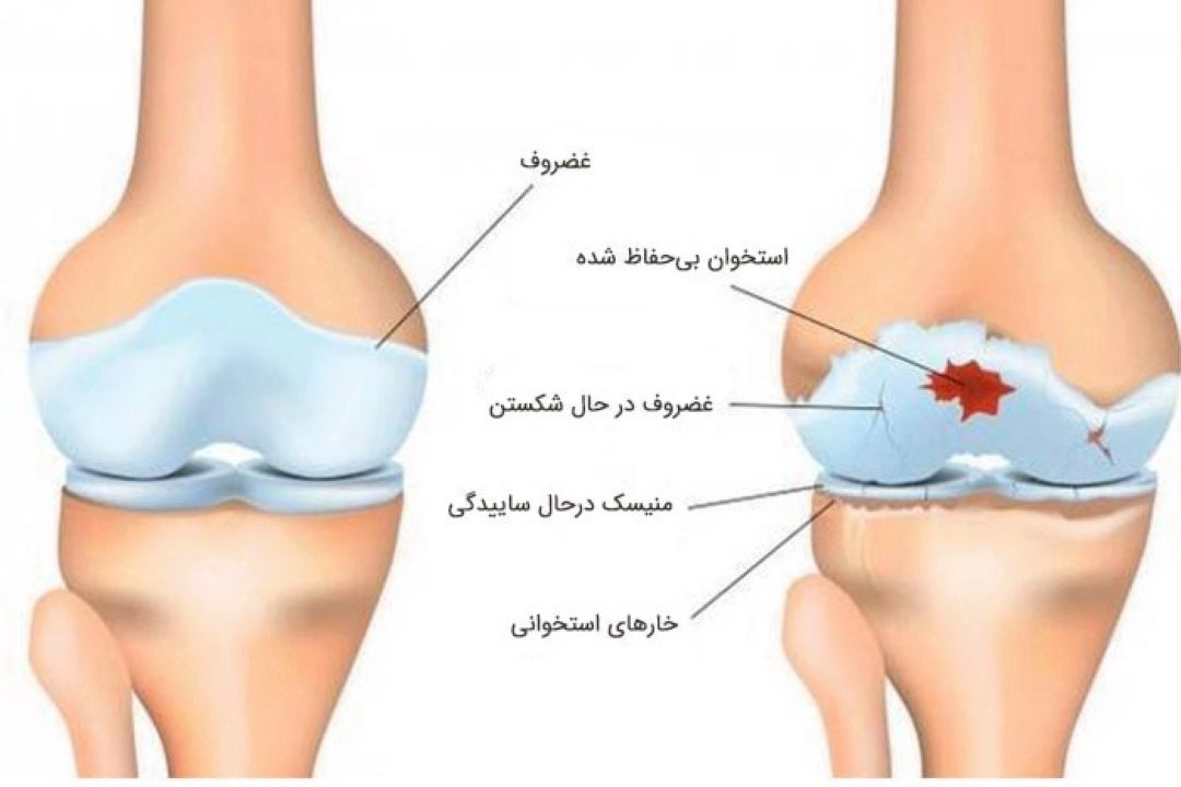 ورزش و بیماری های آرتروز 