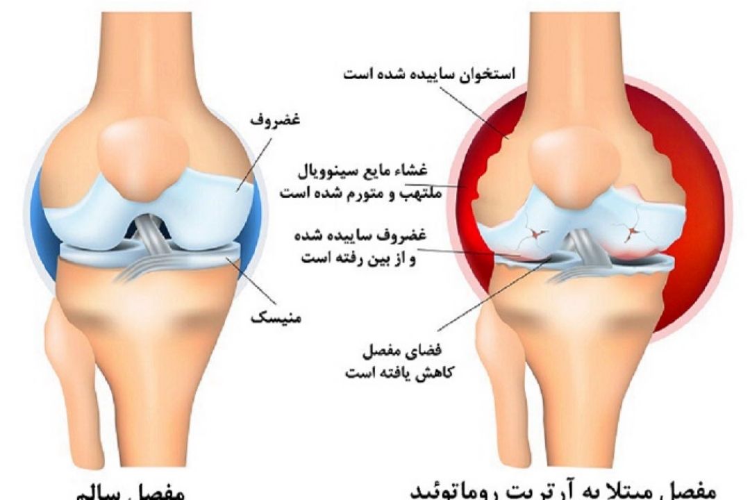 در برنامه نبض سه شنبه اول مرداد درباره سفید كردن دندان ها و روماتیسم مفصلی صحبت شد