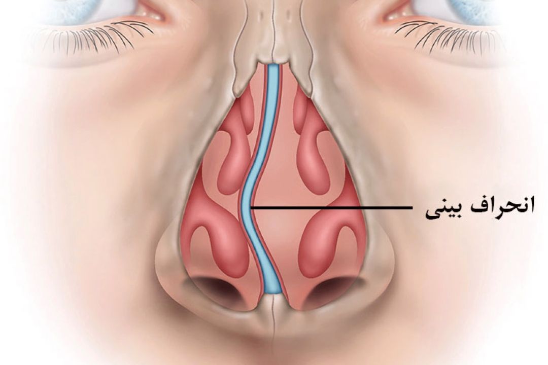 در برنامه نبض یكشنبه دهم شهریور درباره تاثیرات روانی رژیم های لاغری و چاقی و درمان انحراف بینی صحبت شد