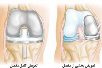 آرتروز زانو 