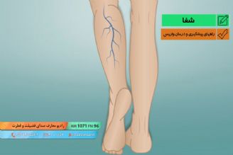 پیشگیری و درمان واریس 