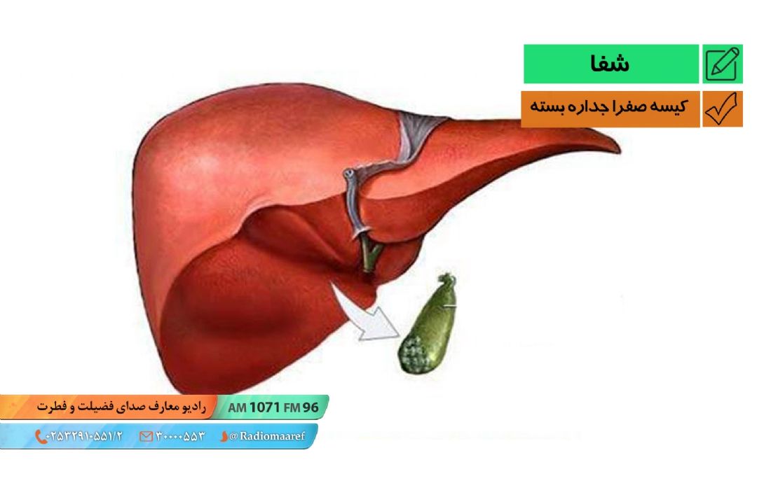 كیسه صفرای جداره بسته