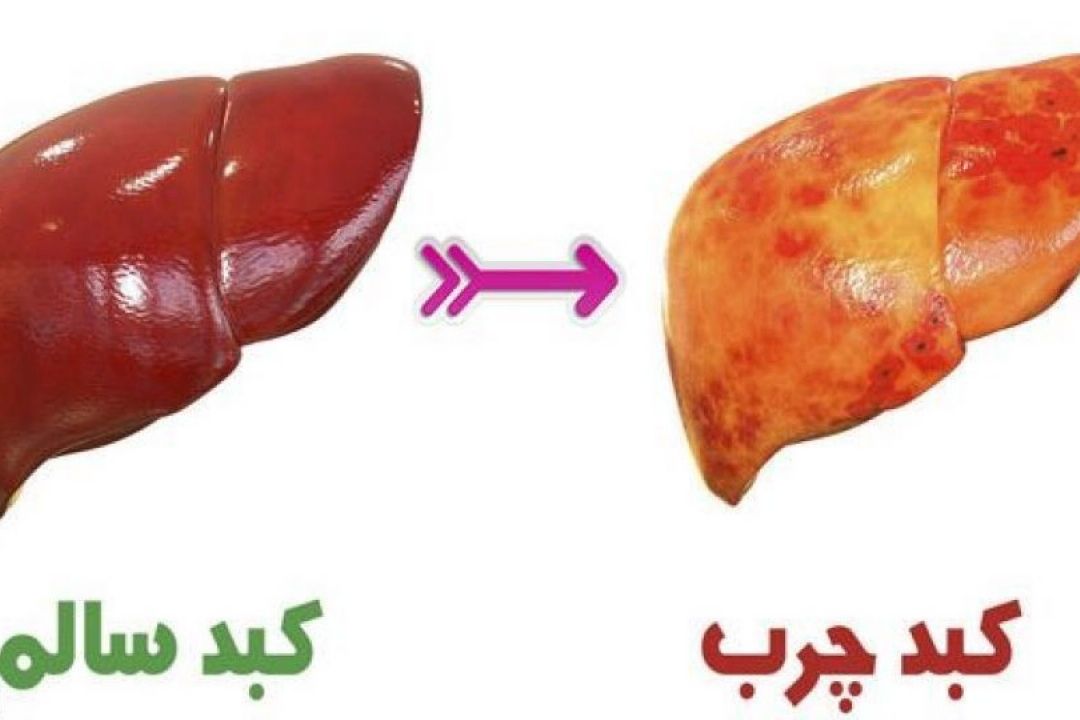 نجات كبد چرب با ورزش