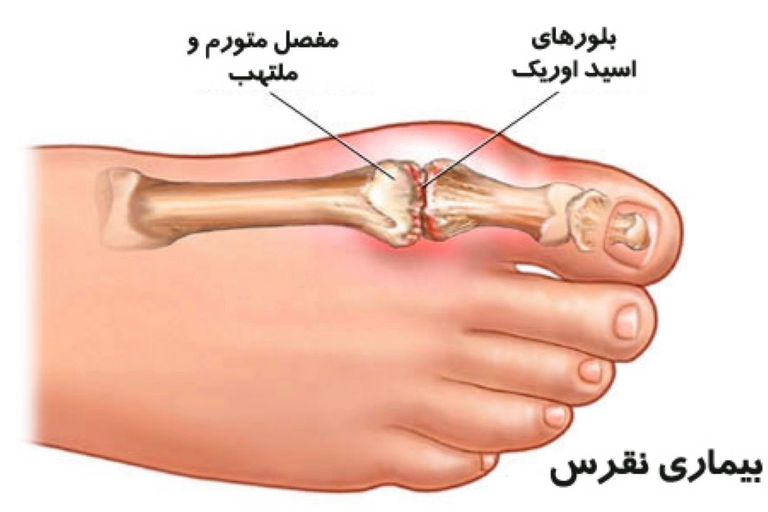 در برنامه نبض چهارشنبه بیست و یكم تیر درباره نقرس صحبت میكنیم