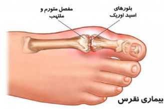 در برنامه نبض چهارشنبه بیست و یكم تیر درباره نقرس صحبت میكنیم