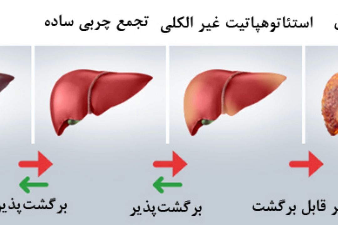 كبد را جدی بگیرید 