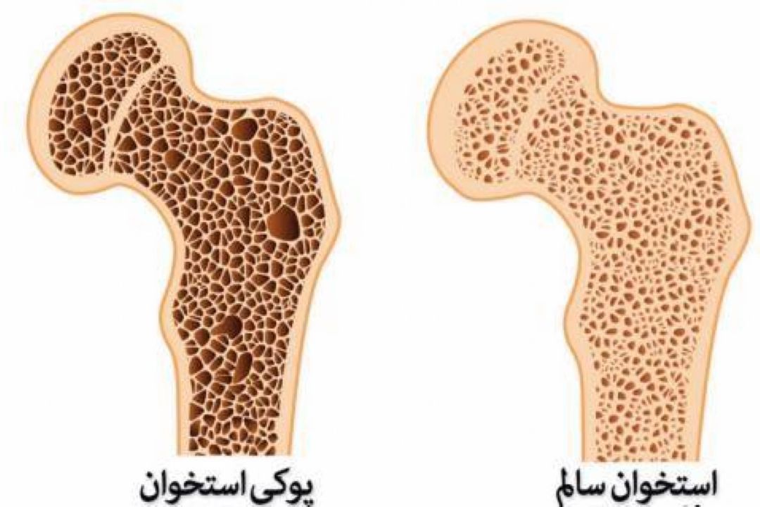 عوامل بروز پوكی استخوان