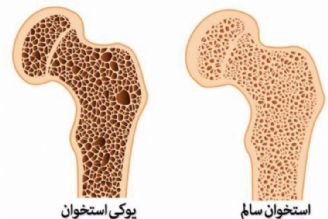 عوامل بروز پوكی استخوان