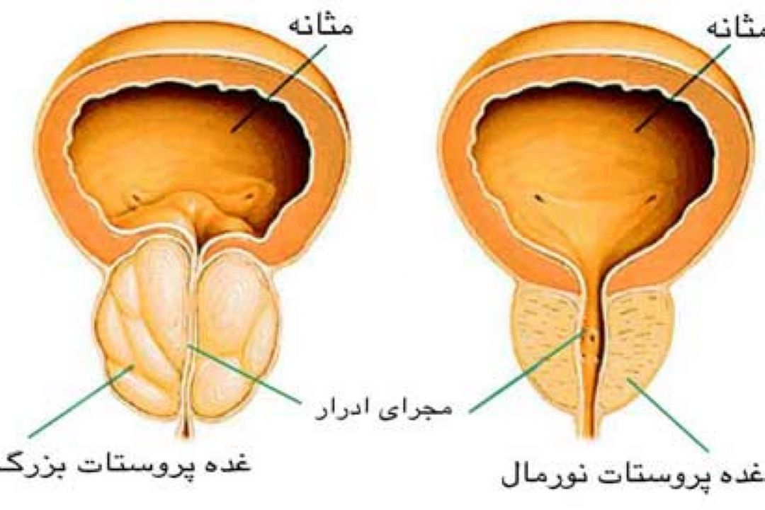 در برنامه نبض چهارشنبه بیست و هشتم تیر درباره  لوله گذاری برای درمان سرطان پروستات صحبت میكنیم