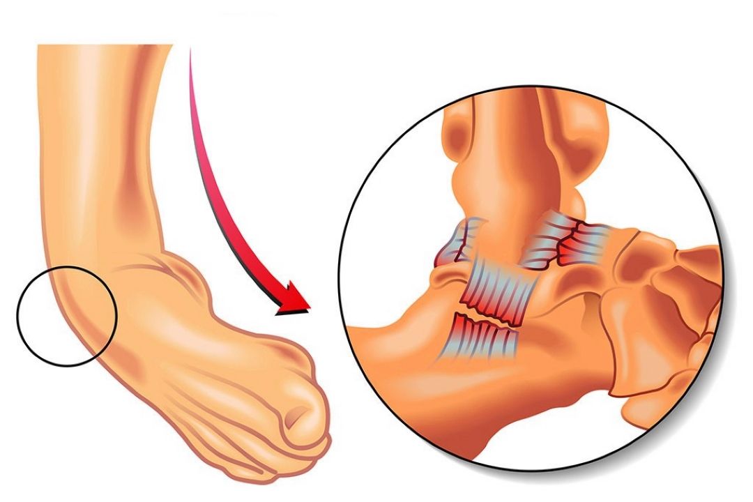 اقدامات لازم در مواجه با پیچ خوردگی مچ پا 