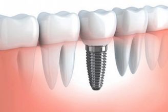 در برنامه نبض چهارشنبه چهارم مرداد درباره ایمپلنت دندانی صحبت میكنیم