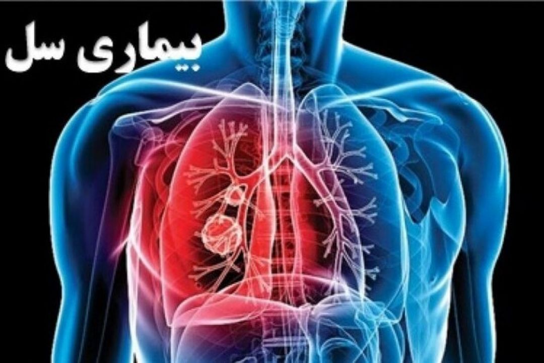 چالش شناسایی مبتلایانِ سل در سال كرونا