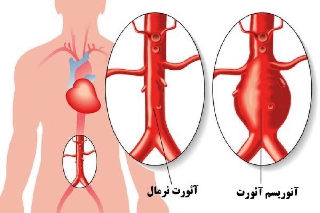 آنوریسم آئورت چیست؟( علائم و روشهای درمانی)