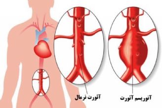 آنوریسم آئورت چیست؟( علائم و روشهای درمانی)