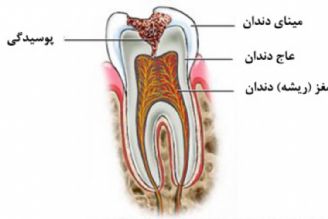 در برنامه نبض چهارشنبه بیست و پنجم مرداد درباره پوسیدگی دندان صحبت میكنیم.