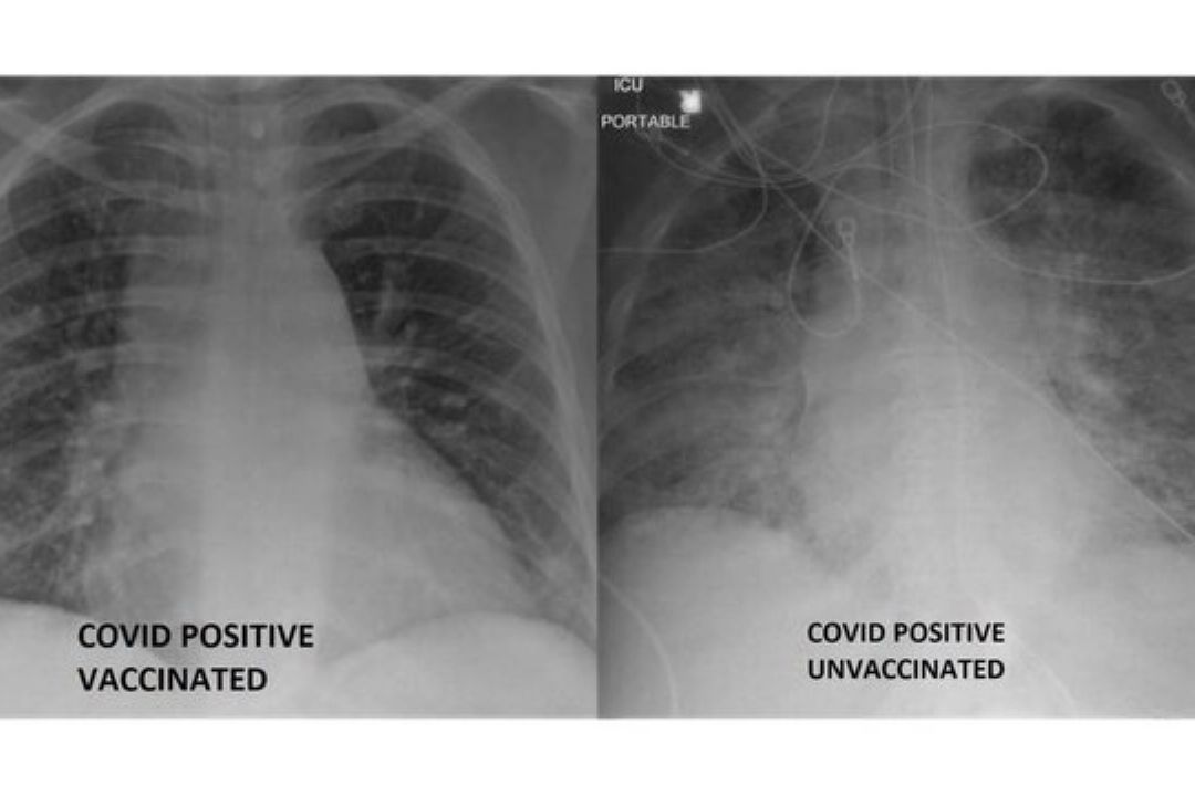 مقایسه تاثیر متفاوت كرونا بر ریه، قبل و بعد از واكسیناسیون
