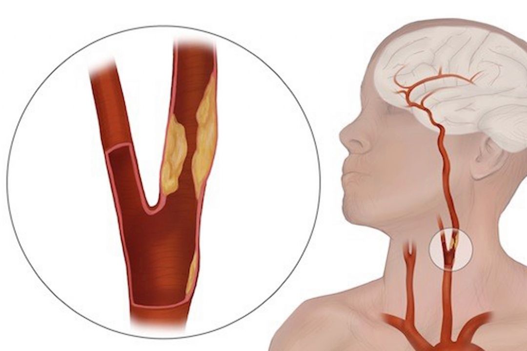 علل سكته مغزی و ارتباط آن با شریان‌های گردن