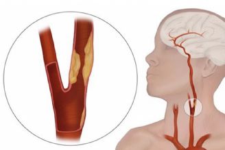 علل سكته مغزی و ارتباط آن با شریان‌های گردن