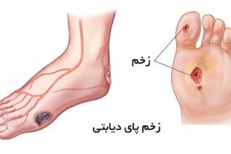 در برنامه نبض یكشنبه دوازدهم شهریور درباره زخم و قطع انگشت پا در فرد مبتلا به دیابت صحبت شد