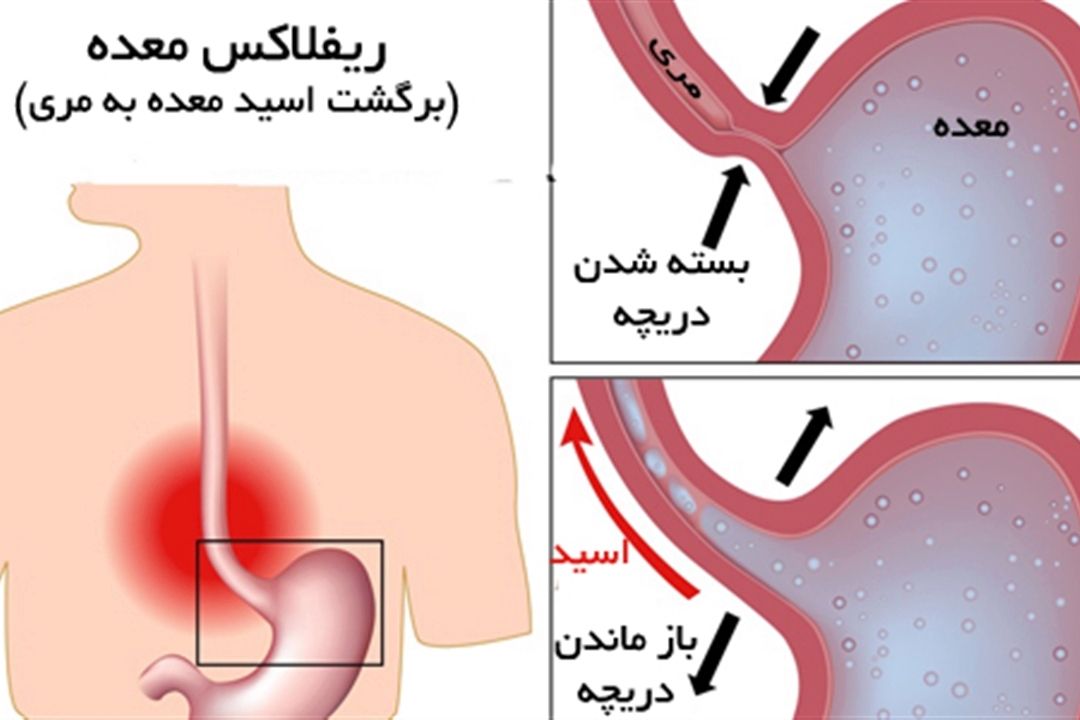 آیا ریفلاكس معده می‌تواند باعث تنگی نفس شود؟