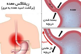 آیا ریفلاكس معده می‌تواند باعث تنگی نفس شود؟