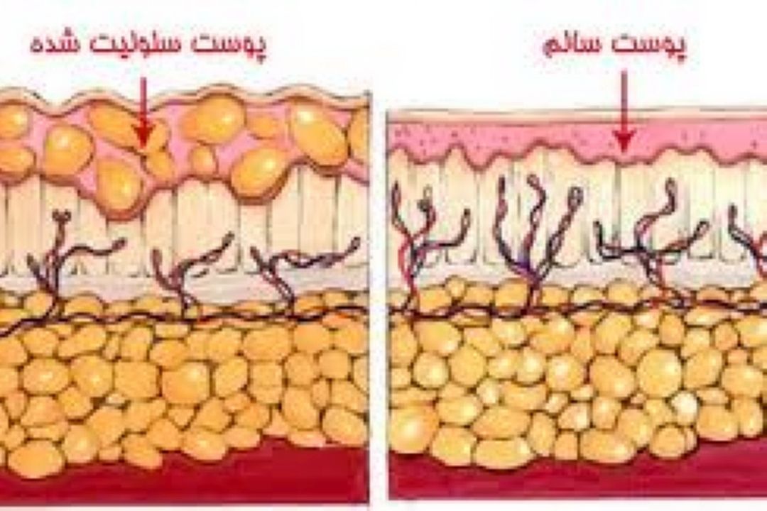 با ورزش سلولیت را رفع كنید