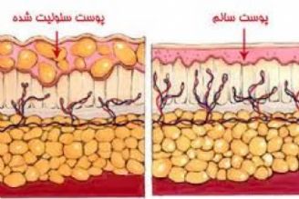 با ورزش سلولیت را رفع كنید