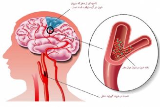 تنگی عروق مغزی چه نشانه هایی دارد؟