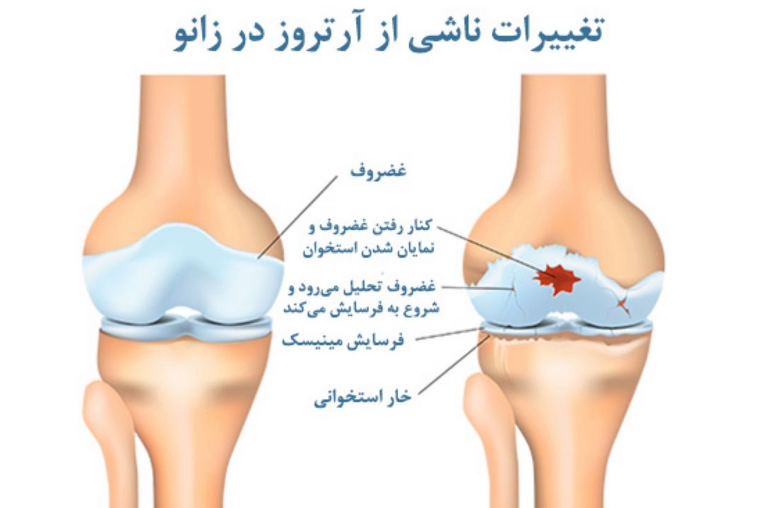 در برنامه نبض یكشنبه نوزدهم شهریور درباره درمان آرتروز زانو صحبت میكنیم.